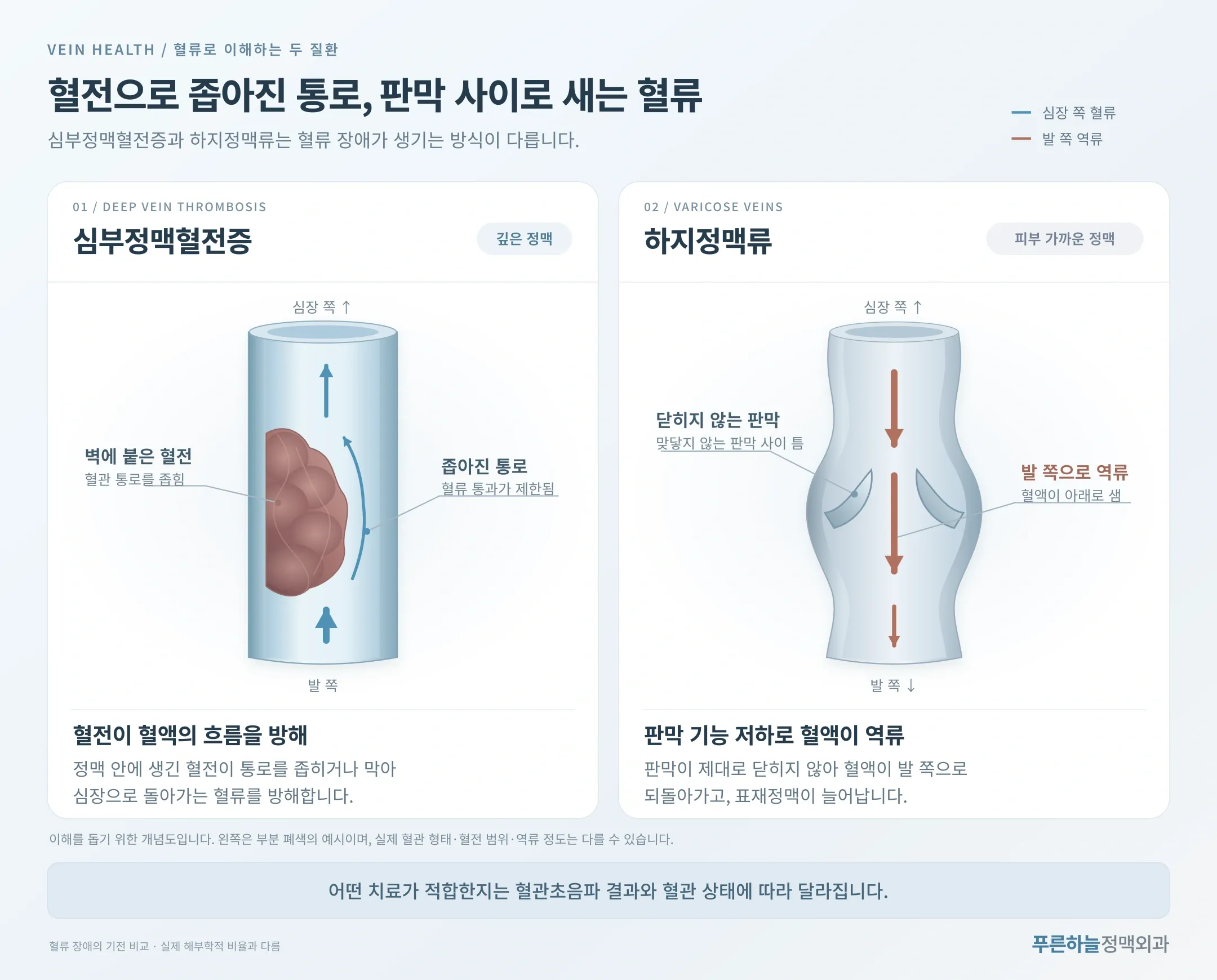 심부정맥혈전증과 하지정맥류의 혈류 차이를 비교한 인포그래픽